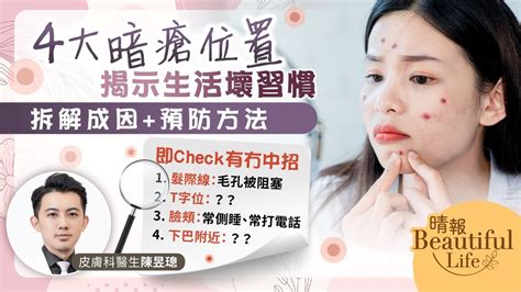 生暗瘡解決|【暗瘡位置】不同代表什麼？中醫教如何處理及預防